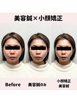 ワッカ 広尾(WACCA)/美容鍼×小顔矯正BeforeAfter 4