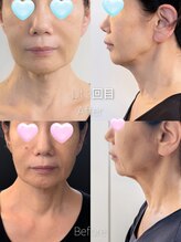 ハッピーコアスマイル(Happy Core Smile)/効果絶大!Lit