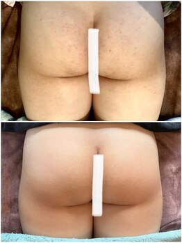 福岡美人工房 アロマムーン/ハーブピーリングはお尻も人気♪