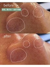 翡翠/小鼻の黒ずみ一度で除去