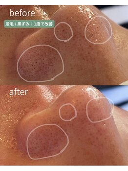 翡翠/小鼻の黒ずみ一度で除去