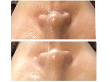 ビーカーブス 三鷹(B.curves)の雰囲気（毛穴、小鼻の赤みもハーブピーリングできれいになります♪ 三鷹）