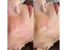 イロドリ(irodori)/敏感肌OK◎ジュエリーピール♪