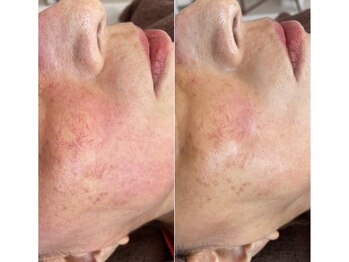 イロドリ(irodori)/敏感肌OK◎ジュエリーピール♪