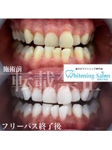 ホワイトニングサロン 福岡天神店/ホワイトニング