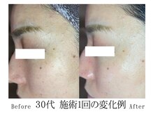 整(totonoi)/毛穴洗浄ベーシック