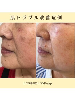 ピーナップ(P-nap)/たるみ、シミ改善