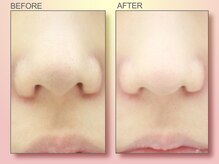 ジュリア オージェ 京橋店/ビフォーアフター（鼻スパ）