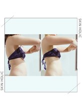スキンホリック 恵比寿駅前店(SKIN HOLIC)/二の腕☆ビフォア＆アフター