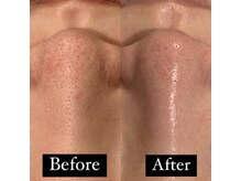 ラノン(LANON)/ビフォーアフター8