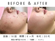 ロエヴェ(ROEWE)/ニキビ改善・毛穴ケア・肌質改善