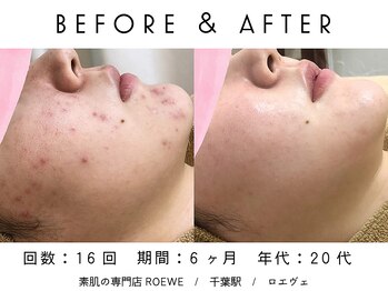 ロエヴェ(ROEWE)/ニキビ改善・毛穴ケア・肌質改善