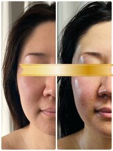 ミロク(369)/小顔、口横ポニョ脂肪分解導入