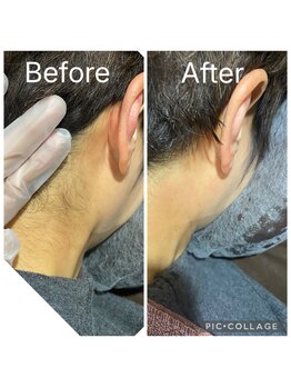 ビマナ 海浜幕張店 夢の樹(NU美Mana)/うなじ脱毛