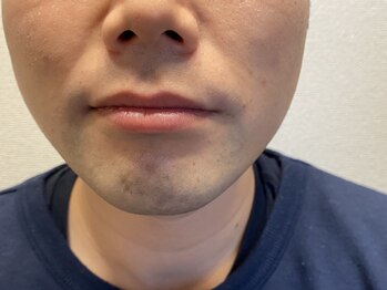 アルシア(ALsia)/ひげ脱毛