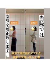 秋田桜トータルケアセンター/姿勢矯正のビフォー・アフター