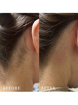 エース(ACE.)/うなじ脱毛でうなじ美人☆