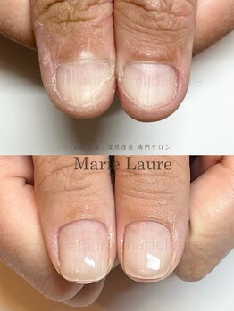 マリーロール 天王寺店(Marie Laure)/自爪育成/深爪矯正/ネイルケア