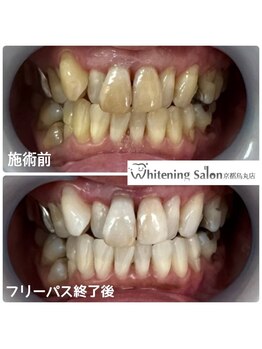 ホワイトニングサロン 京都烏丸店/ホワイトニング施術例