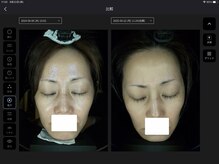 プレジール(Plaisir)/AI肌診断ビフォーアフタ毛穴