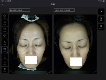 プレジール(Plaisir)/AI肌診断ビフォーアフタ毛穴