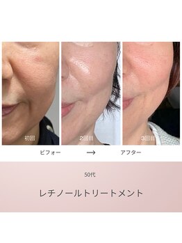 リアン(Lien)/50代 ビフォーアフター