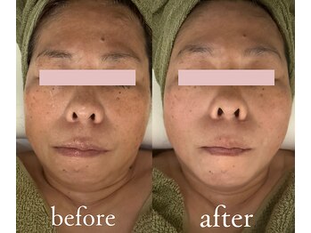 トリートメントルーム フェリーチェ(Felice)/切らずにリフト!顔の重心上向き