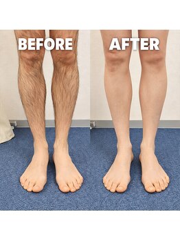 フォーツー 荻窪店(42)/脱毛 下半身のビフォーアフター