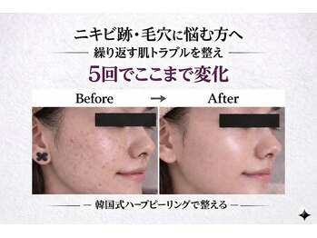 ワイズデュー(Y's Dew)の写真/毛穴黒ずみ・角栓・いちご鼻を押し出さず整える韓国式ハーブピーリングでつるんとなめらかな肌印象へ導く