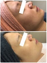 オアジスパ(Oasi Spa)/DTありハーブ２回Beforeafter