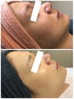 オアジスパ(Oasi Spa)/DTありハーブ２回Beforeafter