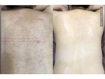 ココ(Coco)/背中毛穴洗浄・ソフトピーリング