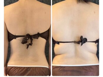 ミカ ネスト(Mika Nest)/カッピング(吸い玉)