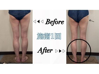 ステラ(Stella)/痩身 (脚・ヒップ周り)