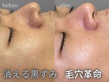 サロンドグレース(Salon de Grace)の雰囲気（トーンアップ、黒ずみ、ざらつきが一回でもここまで変化）