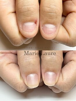 マリーロール 梅田店(Marie Laure)/深爪矯正/自爪育成/ネイルケア