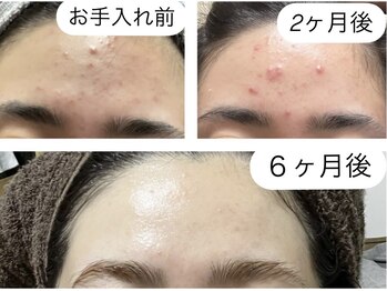 シャインミー(shine me)/ニキビケアにはハーブピーリング