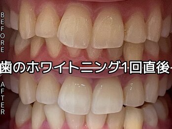 ヴィオール 名古屋栄店(VIOR)/研磨剤不使用！歯に優しい(^_^)