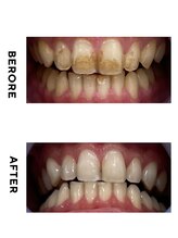 ホワイトニング ショップ 豊見城店/ホワイトニング