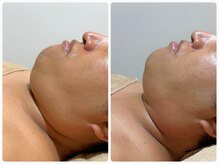 フィフ(fif)/＃レモンボトル#フェイスライン