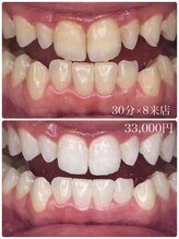 ホワイトニングスタイル 柏店/30分×8来店 33,000円