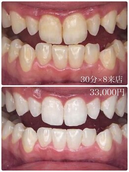 ホワイトニングスタイル 柏店/30分×8来店 33,000円