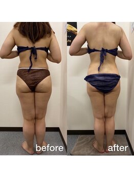 リラクラージュ(Ri Ra Courage)/ 30代3ヶ月後