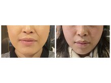 ねこのひげ/小顔美容鍼の結果