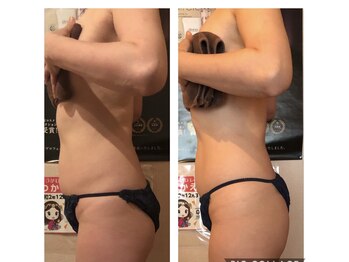 カロン(Kalon)/痩身