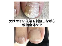 自爪ケアサロン 横浜/足爪ベーシック＋亀裂補修Option