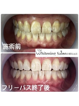 ホワイトニングサロン 京都烏丸店/ホワイトニング施術例