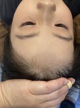 ボンダイボディー(Bondi Body)/キッズ部分脱毛