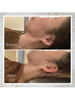 プレミドール(PREMIDOLL)/Before After/小顔矯正