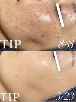 ミエル(miel)/【シミしわ】エイジングケア